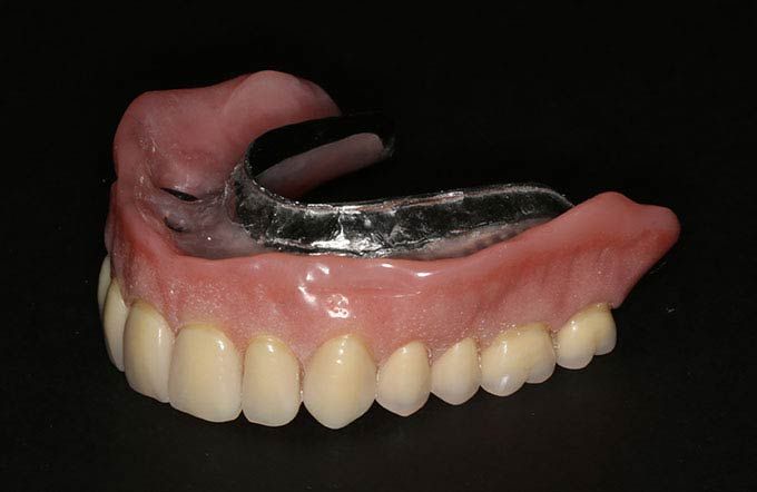 Implant retained dentures