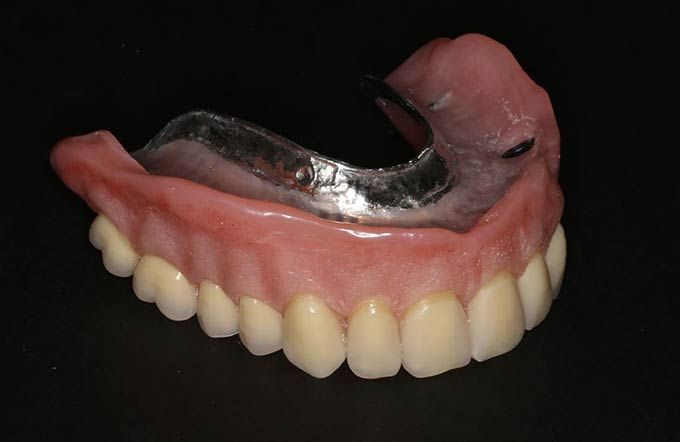 Implant retained dentures