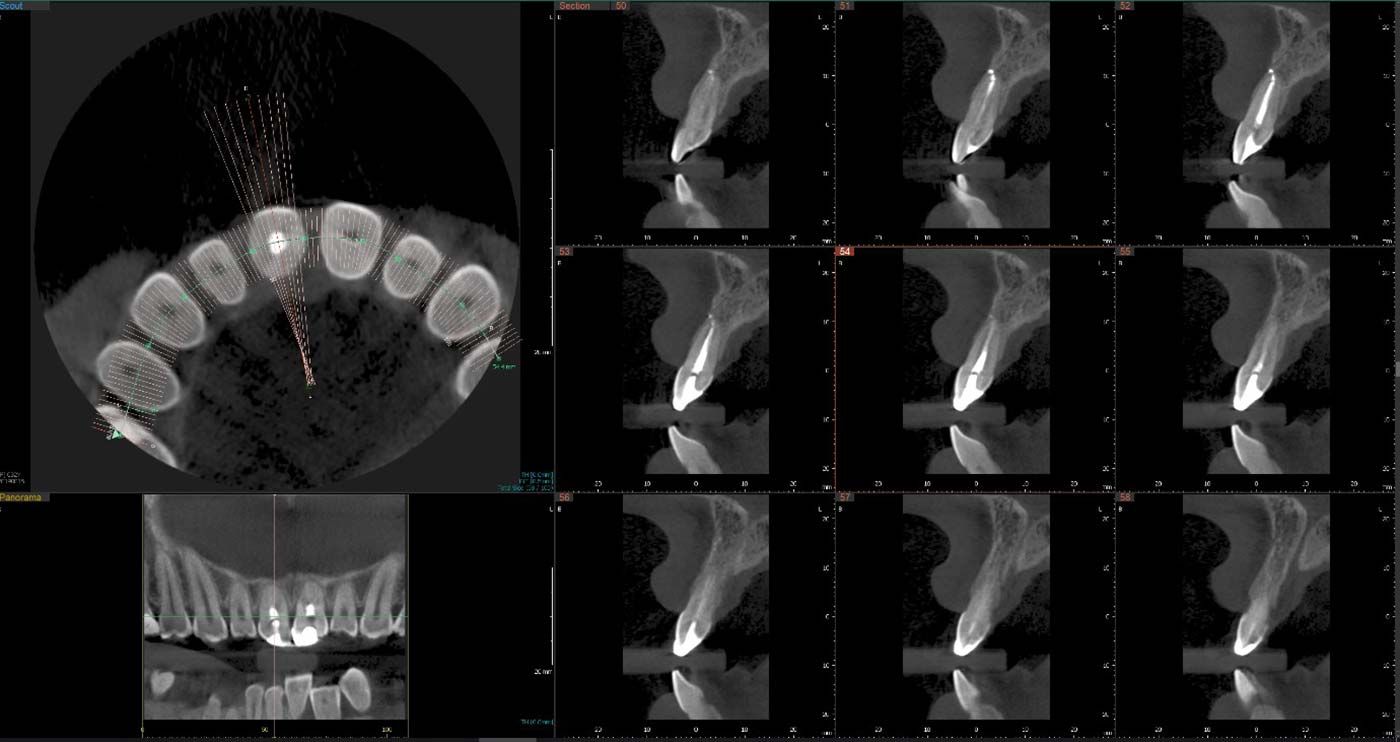 3d-xray-scanning-CBCT-anterior-root-canal-treated-teeth