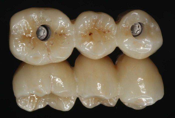 Custom Made Tooth Replacements