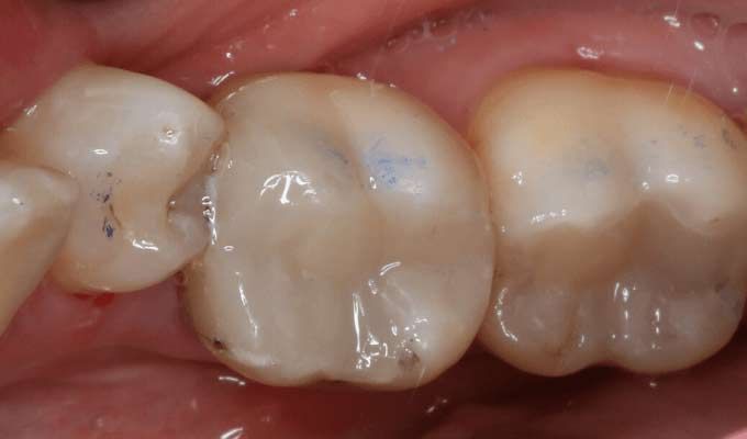 After Restorative Dental Treatment