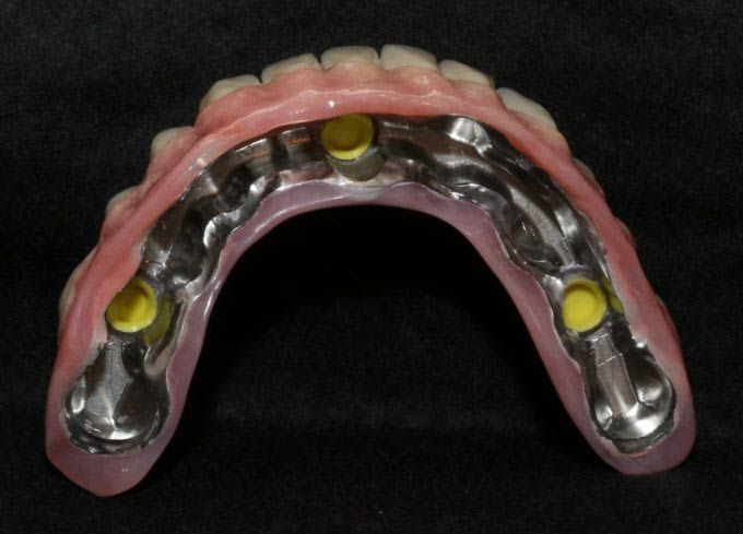 Implant retained dentures