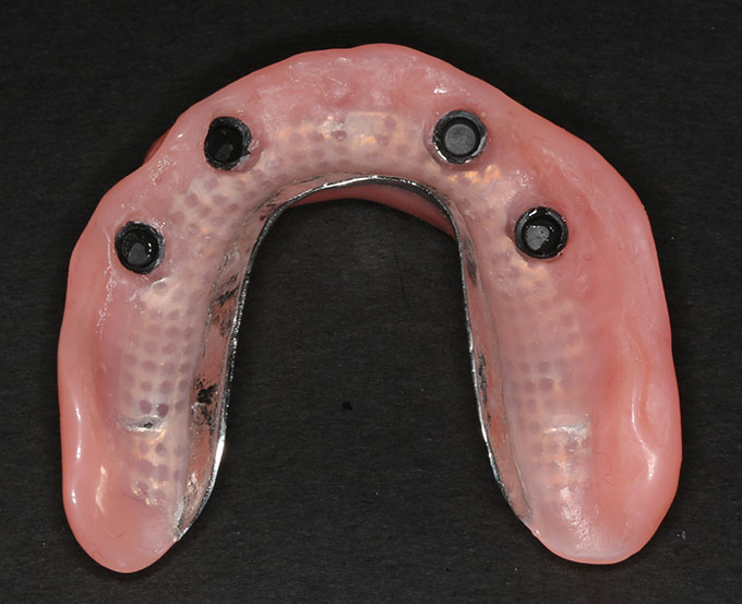 Implant Supported Dentures Waterside Dentalcare